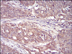 Immunohistochemical analysis of paraffin-embedded Human cervical cancer tissue labeling RSK3 with ab201988 at 1/200 dilution.
