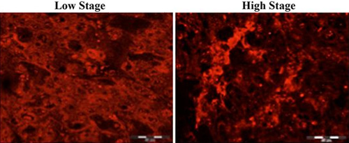 Immunohistochemical analysis of Human renal cancer tissue, staining Rubicon with ab92388. Tissue was fixed with acetone and incubated with primary antibody. A Cy3-conjugated anti-rabbit IgG was used as the secondary antibody.