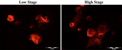 Immunohistochemical analysis of Human renal tumour cells, staining Rubicon with ab92388. Cells were fixed with acetone and incubated with primary antibody. A Cy3-conjugated anti-rabbit IgG was used as the secondary antibody.