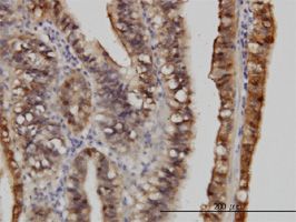 S100 alpha 6 antibody (ab55680) used in immunohistochemistry at 3ug/ml on formalin fixed and paraffin embedded human stomach carcinoma.