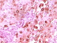 ab36603, at a dilution of 1/100-1/500 staining paraffin embedded human brain glioma tissue showing nuclear localization, by immunohistochemistry with DAB staining.