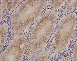 Immunohistochemical analysis of paraffin-embedded Human colonic carcinoma tissue labeling S100 alpha 6 with ab181974 at 1/50 dilution, followed by prediluted ImmunoHistoprobe (Ready to use) HRP Polymer for Rabbit IgG. Counter stained with Hematoxylin.