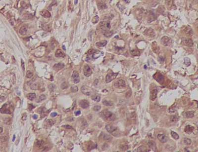 Immunohistochemical analysis of paraffin-embedded Human colonic carcinoma tissue labeling S100 alpha 6 with ab181975 at 1/100 dilution, followed by prediluted ImmunoHistoprobe (Ready to use) HRP Polymer for Rabbit IgG. Counter stained with Hematoxylin.