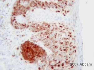 Unpurified ab52642 at 1/500 staining human melanoma tissue sections by IHC-P. The tissue was formladehyde fixed and a heat mediated antigen retrieval step was performed, before being blocked and incubated with the antibody for 1 hour. An HRP conjugated goat anti-rabbit antibody was used as the secondary.See Abreview