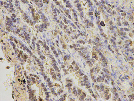 Immunohistochemistry (Formalin/PFA-fixed paraffin-embedded sections) analysis of human lung cancer tissue labelling S100A11 with ab187180 at 1/200. Magnification: 400x.