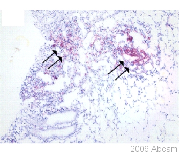 Anti-S100A12 antibody (ab37657) detects macrophage infiltrates expressing S100A12 in colon tissues from a patient with Crohn’s disease.