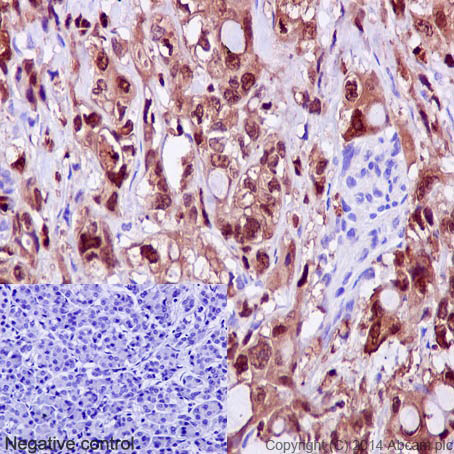 Immunohistochemical staining of paraffin embedded human pancreatic adenocarcinoma with purified ab124743 at a working dilution of 1 in 300. The secondary antibody used is a HRP polymer for rabbit IgG. The sample is counter-stained with hematoxylin. Antigen retrieval was perfomed using Tris-EDTA buffer, pH 9.0. PBS was used instead of the primary antibody as the negative control, and is shown in the inset.
