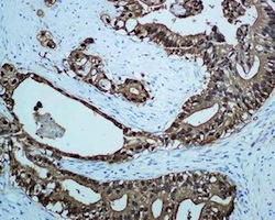 Unpurified ab124743, at 1/500 dilution, staining S100P in paraffin-embedded human pancreatic adenocarcinoma tissue by immunohistochemistry.