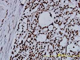Nucleophosmin antibody (ab55708) used in immunohistochemistry at 5ug/ml on formalin fixed and paraffin embedded human ovary, clear cell carcinoma tissue.