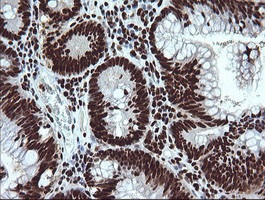 Immunohistochemical analysis of paraffin-embedded Human colon adenocarcinoma tissue labelling SAE1 with ab140964 at 1/150 dilution.