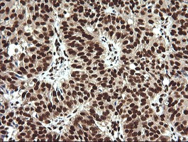 Immunohistochemical analysis of paraffin-embedded Human ovary adenocarcinoma tissue labelling SAE1 with ab140964 at 1/150 dilution.
