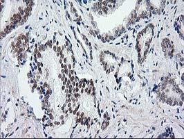 ab118404 at 1/50 dilution staining SAE2 / UBA2 in Paraffin-embedded Human Prostate carcinoma tissue by Immunohistochemistry.