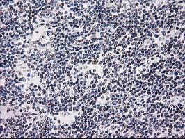 ab118404 at 1/150 dilution staining SAE2 / UBA2 in Paraffin-embedded Human Lymphoma tissue by Immunohistochemistry.