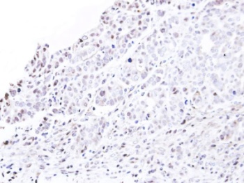 ab95956, at a 1/500 dilution, staining Nucleoporin p62 in paraffin embedded NCIN87 xenograft.