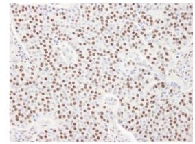 ab84671 at 1/100 dilution, staining SART3 in Formalin-Fixed Paraffin-Embedded Human pancreatic islet cell tumor tissue by Immunohistochemistry. Detection: DAB staining