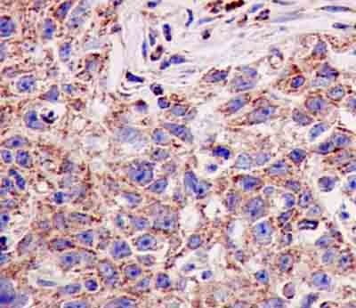 Immunohistochemical analysis of paraffin-embedded Human squamous cell lung carcinoma tissue labeling SCDGFB using ab181845 at 1/100 dilution. A ready to use HRP Polymer for Rabbit IgG prediluted was used as secondary. Counterstain: Hematoxylin.
