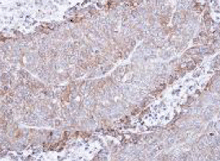 Immunohistochemical analysis of paraffin-embedded Human DLD1 xenograft tissue labeling Nicotinic Acetylcholine Receptor alpha 4 with ab151596 at 1/100 dilution.