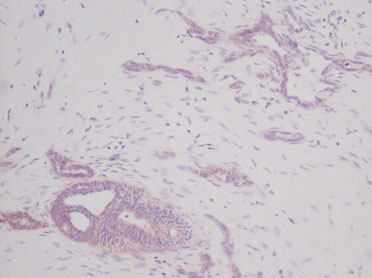 ab9716 staining SCF in human pancreatic adenocarcinoma tissue section by Immunohistochemistry (Formalin/PFA fixed paraffin-embedded sections). Tissue underwent proteinase K mediated antigen retrieval at room temperature. The primary antibody was used at 0.5 ug/ml and incubated with sample at 4°C overnight. A HRP-labeled polymer detection system was used with an alcohol-soluble AEC chromogen.
