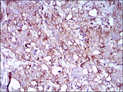 Immunohistochemical analysis of paraffin embedded Human cervical cancer tissue labeling SCP3 with ab181746 at 1/200.
