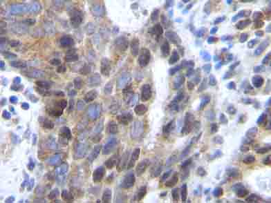 ab9797 staining SDF1 alpha in human colorectal adenocarcinoma tissue by Immunohistochemistry (Formalin/PFA fixed paraffin-embedded sections). Tissue underwent heat mediated antigen retrieval in sodium citrate buffer (pH 6.0). The primary antibody was used at 0.5 ug/ml and incubated with sample at 4°C overnight. A HRP-labeled polymer detection system was used with a DAB chromogen.