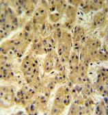 ab102660, at a 1/50 dilution, staining human SEC24A in hepatocarcinoma, using Immunohistochemistry, Formalin/PFA-fixed paraffin-embedded tissue. Followed by peroxidase conjugation of a secondary antibody and DAB staining.