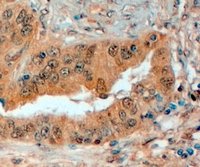 ab112886 at 4&microg/ml showing membranous staining of Semaphorin 3E in the secretory cells of Paraffin-embedded Human Prostate tissue by Immunohistochemistry. Detection utilised HRP staining.