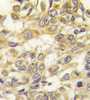 Immunohistochemistry analysis of formalin-fixed, paraffin-embedded Human breast carcinoma tissue using ab80068 at a 1/10 dilution, with a peroxidase-conjugated secondary antibody, followed by DAB staining.