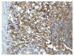 Immunohistochemical analysis of paraffin embedded Human colon tissue labelling Semaphorin 4D using ab134128 at 1/100 dilution. Positive staining of lymphocytes inclusion.