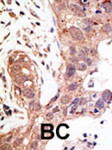 ab3657 staining SENP1 in human breast carcinoma (BC) tissue by Immunohistochemistry (Formalin/PFA-fixed paraffin-embedded sections).