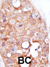 ab3660 staining SENP2 in human breast carcinoma (BC) tissue by Immunohistochemistry (Formalin/PFA-fixed paraffin-embedded sections).