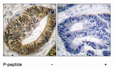Paraffin-embedded human colon carcinoma tissue stained for Separase using ab52210 (1/100). The right hand panel represents a negative control where ab52210 was pre-incubated with the immunising (blocking) peptide.