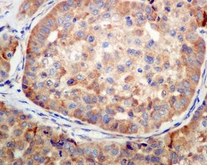 Immunohistochemical analysis of paraffin-embedded Human hepatocellular carcinoma tissue labelling SERCA2 ATPase with ab137020 at 1/100 dilution.