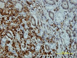  Serine/threonine-protein kinase 4antibody (ab57836) used in immunohistochemistry at 5ug/ml on formalin fixed and paraffin embedded human stomach carcinoma tissue.