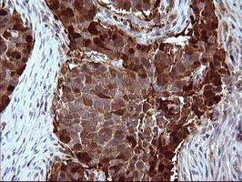 Immunohistochemical analysis of paraffin-embedded Human lung carcinoma tissue, labeling SerpinB3 using ab180396 at a 1/150 dilution.