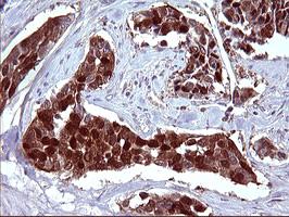 Immunohistochemical analysis of paraffin-embedded Human bladder carcinoma tissue, labeling SerpinB3 using ab180396 at a 1/150 dilution.