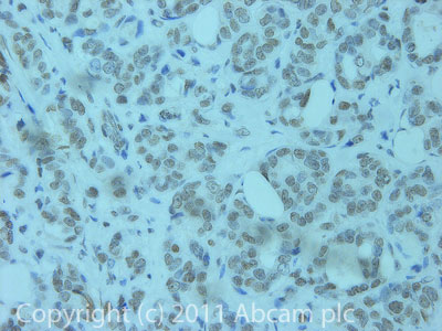 IHC image of ab67156 staining in Breast Cancer formalin fixed paraffin embedded tissue section, performed on a Leica BondTM system using the standard protocol F. The section was pre-treated using heat mediated antigen retrieval with sodium citrate buffer (pH6, epitope retrieval solution 1) for 20 mins. The section was then incubated with ab67156, at 5µg/ml, for 15 mins at room temperature and detected using an HRP conjugated compact polymer system. DAB was used as the chromogen. The section was then counterstained with haematoxylin and mounted with DPX.For other IHC staining systems (automated and non-automated) customers should optimize variable parameters such as antigen retrieval conditions, primary antibody concentration and antibody incubation times.