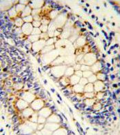 Immunohistochemical analysis of formalin-fixed and paraffin-embedded Human colon carcinoma tissue labelling SF2 with ab135617 at 1/50 dilution followed by peroxidase-conjugated secondary antibody and DAB staining.
