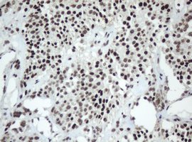 Immunohistochemical analysis of paraffin-embedded Human pancreas carcinoma tissue labelling SF3A1 with ab139271 at 1/500 dilution