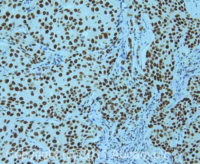 IHC image of NuMA staining in human breast adenocarcinoma formalin fixed paraffin embedded tissue section, performed on a Leica BondTM system using the standard protocol F. The section was pre-treated using heat mediated antigen retrieval with sodium citrate buffer (pH6, epitope retrieval solution 1) for 20 mins. The section was then incubated with ab86129, 1µg/ml, for 15 mins at room temperature and detected using an HRP conjugated compact polymer system. DAB was used as the chromogen. The section was then counterstained with haematoxylin and mounted with DPX. For other IHC staining systems (automated and non-automated) customers should optimize variable parameters such as antigen retrieval conditions, primary antibody concentration and antibody incubation times
