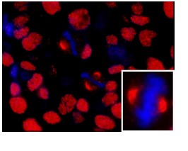 ab84680, at 1/100 dilution, staining NuMA in formalin-fixed, paraffin-embedded human breast carcinoma by Immunohistochemistry using a Red-fluorescent goat anti-rabbit IgG highly cross-adsorbed Hilyte PlusTM 555 secondary antibody at a dilution of 1/100.