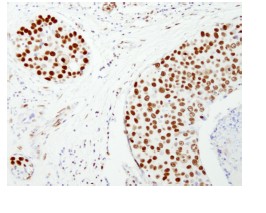 ab84680, at 1/250 dilution, staining NuMA in formalin-fixed, paraffin-embedded human breast carcinoma by Immunohistochemistry using DAB staining.