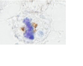 ab84680, at 1/250 dilution, staining NuMA in formalin-fixed, paraffin-embedded human seminoma by Immunohistochemistry using DAB staining.
