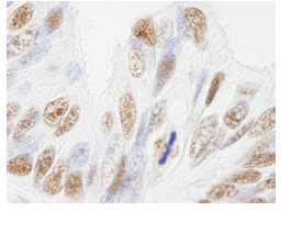 ab84680, at 1/250 dilution, staining NuMA in formalin-fixed, paraffin-embedded human ovarian tumor by Immunohistochemistry using DAB staining.