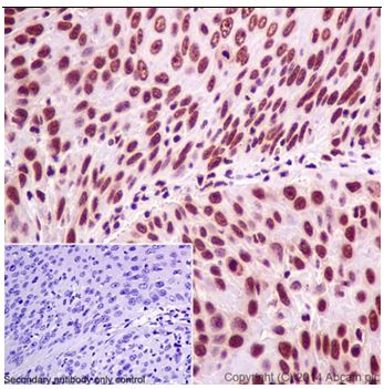 Immunohistochemical analysis of paraffin-embedded Human cervix carcinoma tissue labeling SFRS3 with ab198291 at 1/500 dilution followed by Goat Anti-Rabbit IgG H&L (HRP) (ab97051) at 1/500 dilution. Nuclear staining on Human cervix carcinoma tissue is observed. Counter stained with Hematoxylin.Negative control: Used PBS instead of primary ab.