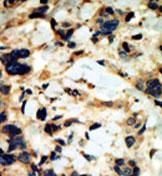 Formalin fixed and paraffin embedded human breast carcinoma tissue reacted with ab71616 at a 1/50 dilution. ab71616 was peroxidase conjugated to the secondary antibody, followed by DAB staining.