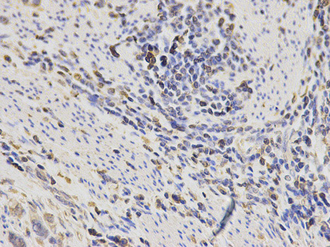 Immunohistochemistry (Formalin/PFA-fixed paraffin-embedded sections) analysis of human stomach cancer tissue labelling SH2D1A/SAP with ab185810 at 1/200. Magnification: 400x.