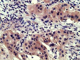 ab114012 at 1/150 dilution staining SH3 containing Grb 2 like 1 in Human bladder carcinoma tissue by immunohistochemistry (FFPE).