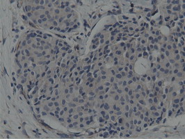 ab119003, at a 1/150 dilution, staining SH3 containing Grb 2 like 1 protein in paraffin embedded Human breast adenocarcinoma tissue by Immunohistochemistry.