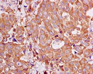 Immunohistochemical analysis of paraffin-embedded Human breast carcinoma tissue labeling SH3D20 with ab171973 at 1/100 dilution.