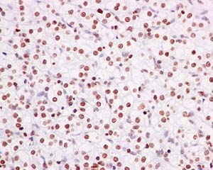 Immunohistochemical analysis of paraffin-embedded Human clear cell carcinoma of kidney tissue labeling Nup107 with ab182559 at 1/50 dilution followed by prediluted HRP Polymer for Rabbit IgG. Counter stained with hematoxylin.
